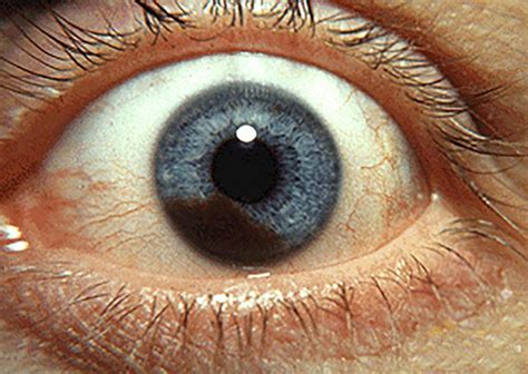 symptoms of ocular melanoma in eye